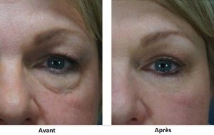 photo avant apres - blepharoplastie tunisie
