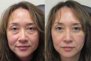 blepharoplastie avant apres