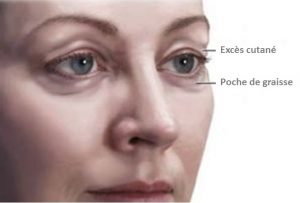 chirurgie paupieres Tunisie